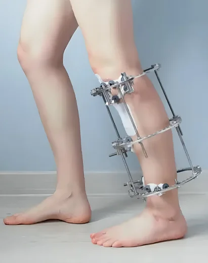 lower limb reconstruction surgery treatment in India